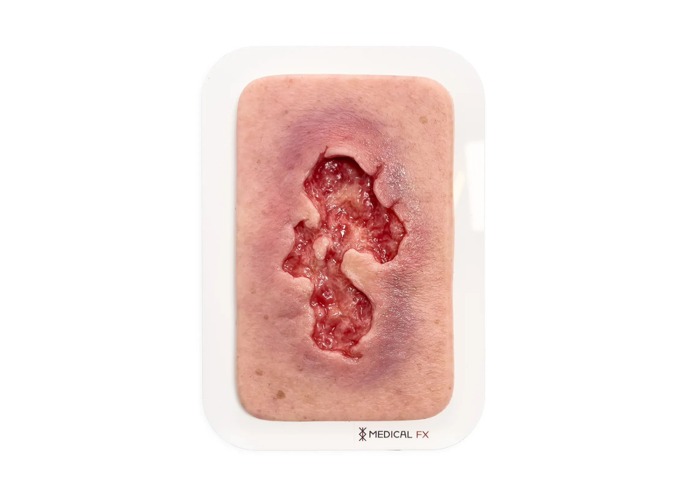 Pocketwound Ulcer - Chronic wound