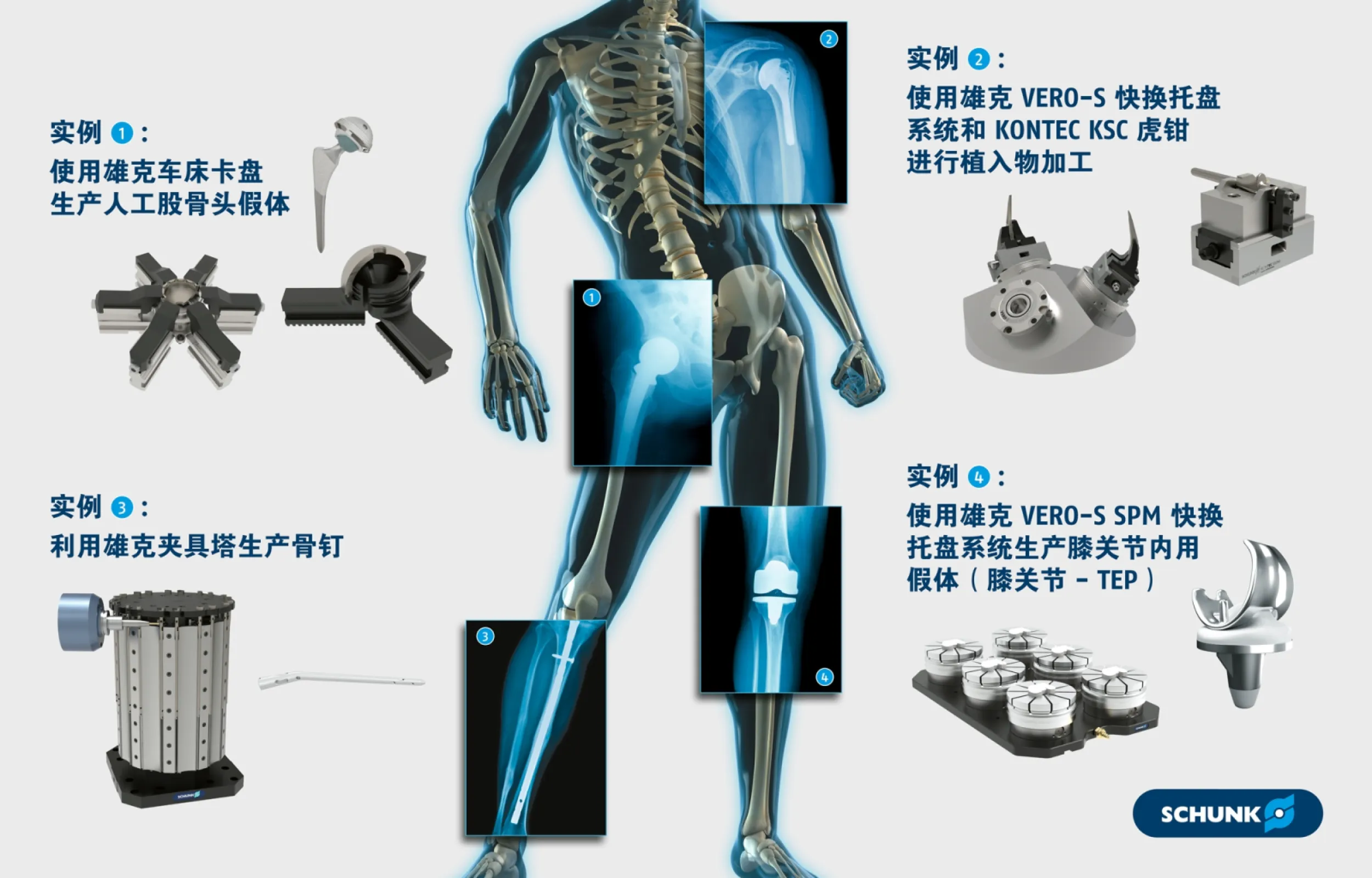 SCHUNK Orthopedic Implants: Application Cases