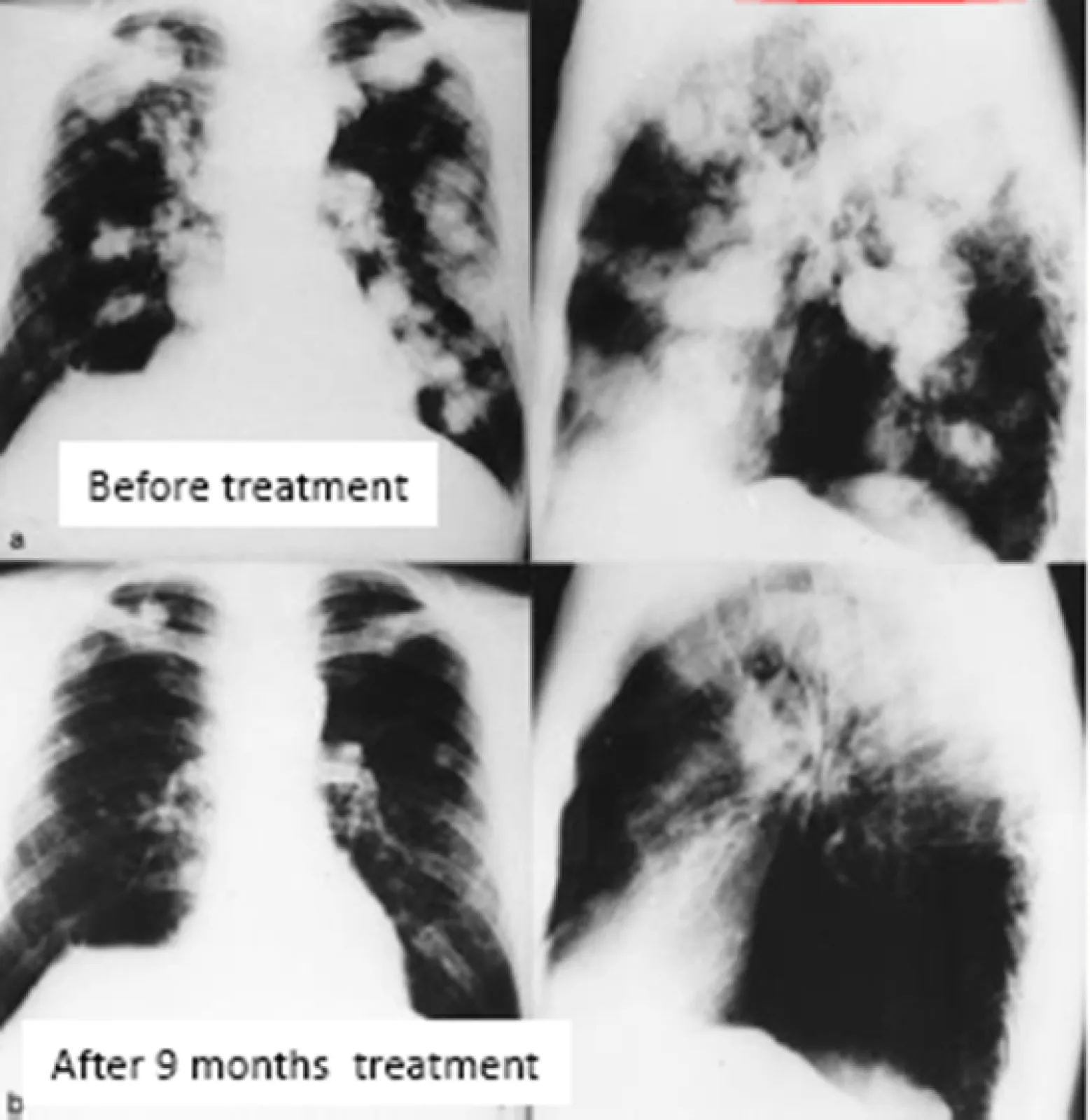 Patient X001 before and after mainly inhalation IL-2 therapy -significant partial response  achieved