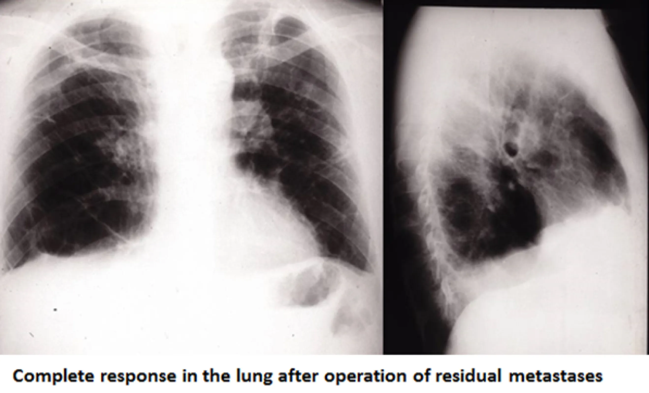 Patient X001 due to excellent response to IL-2inhalation therapy removal of all residual metastases was possible - complete response
