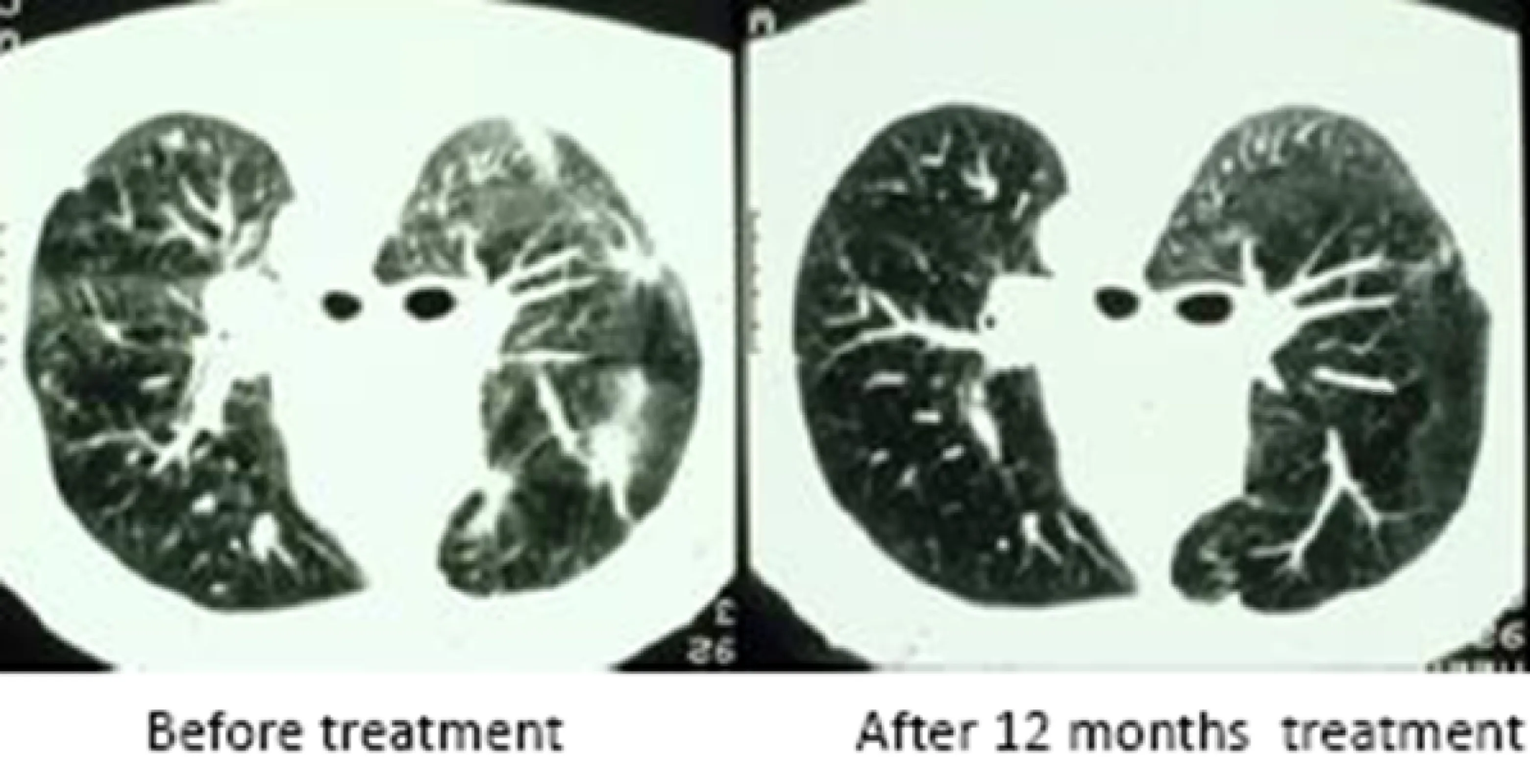 Patient X003 CT  scan before and after 12 months of mainly  IL-2 inhalation therapy