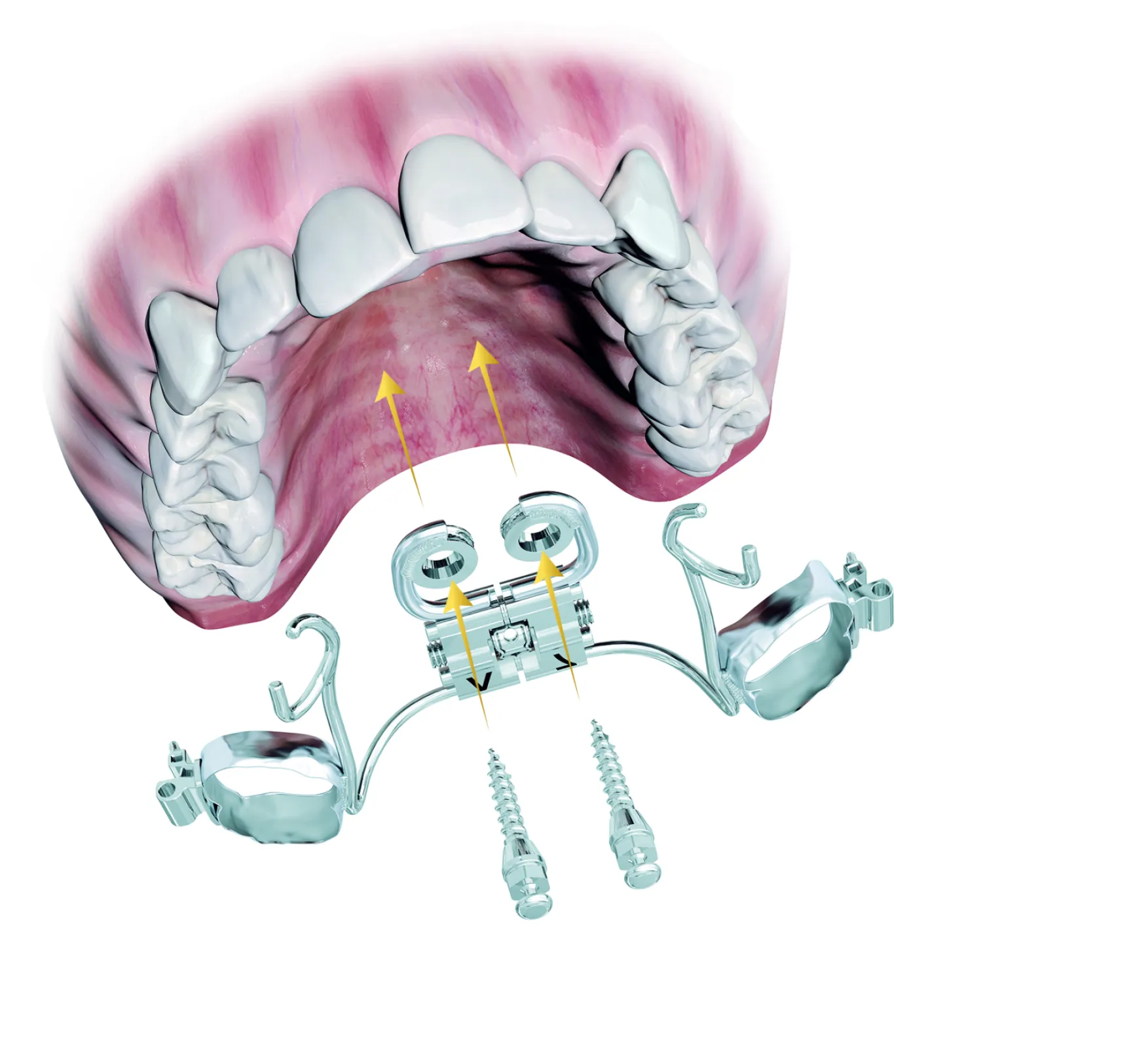 Skeletal anchoring according to the Pin-Last© concept.