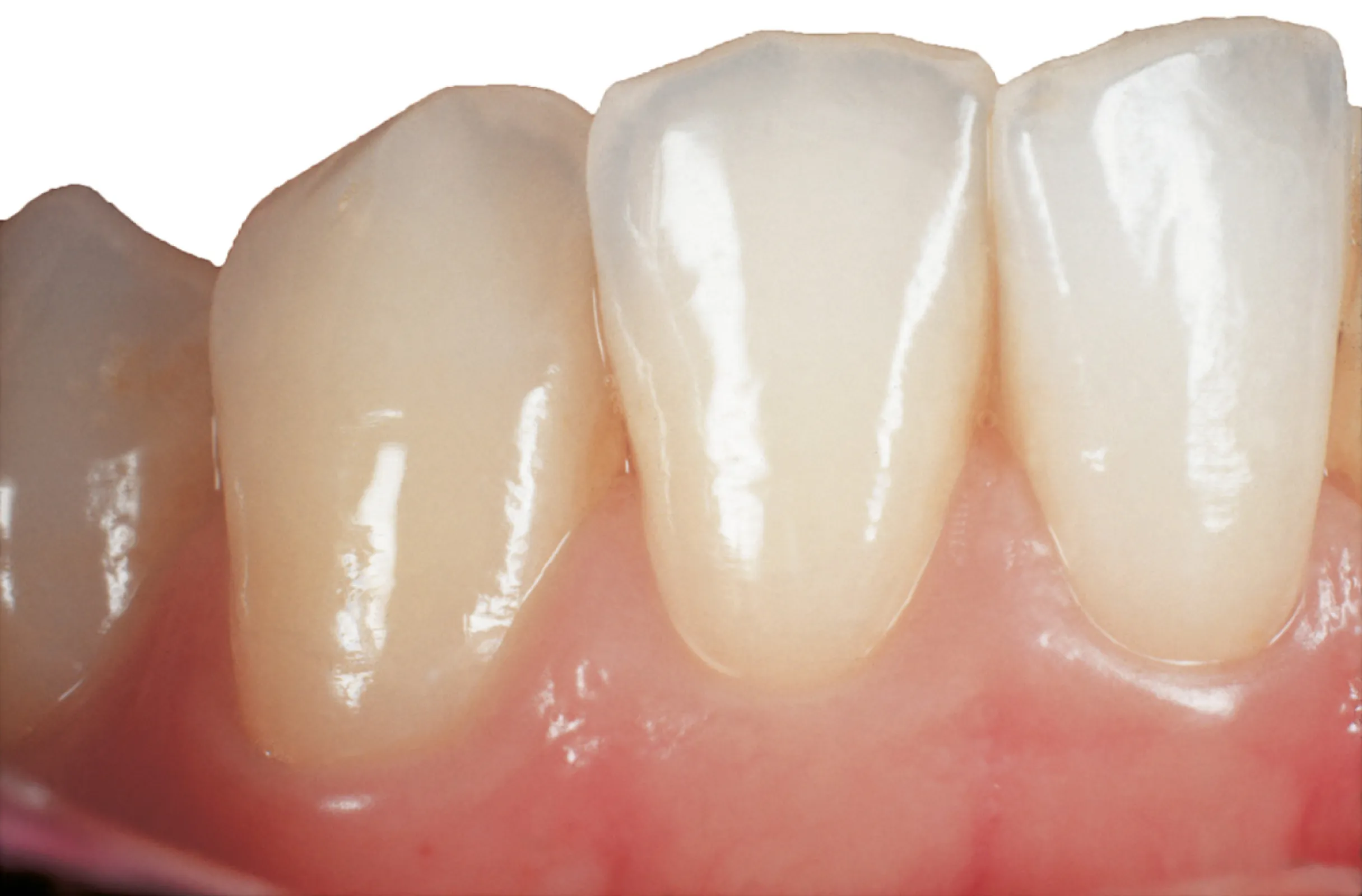 Aesthetics realized with Triceram® by Dentaurum.