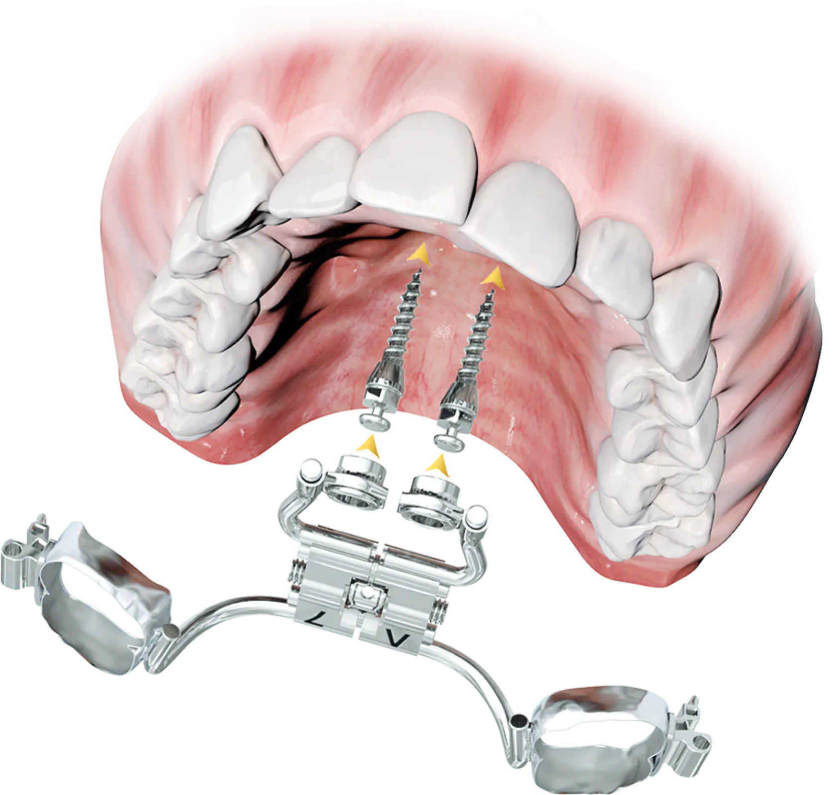 Skeletal anchoring according to the Pin-First© concept.