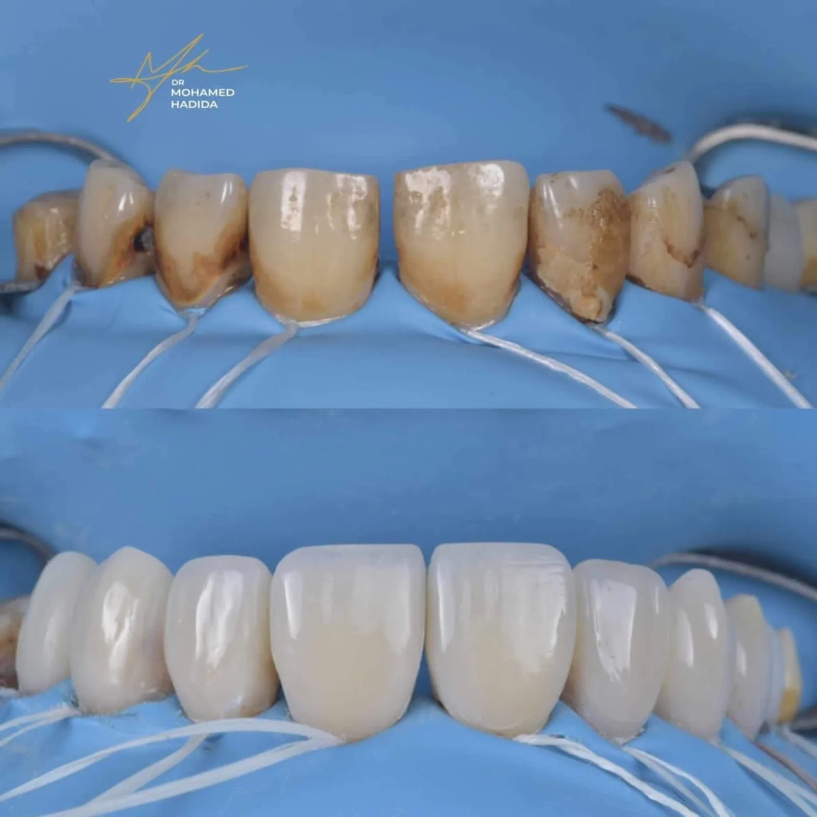 Restoration with Nanofill unique