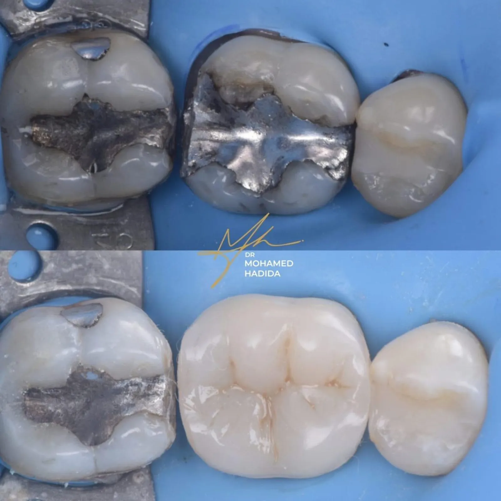 Restoration with Nanofill unique