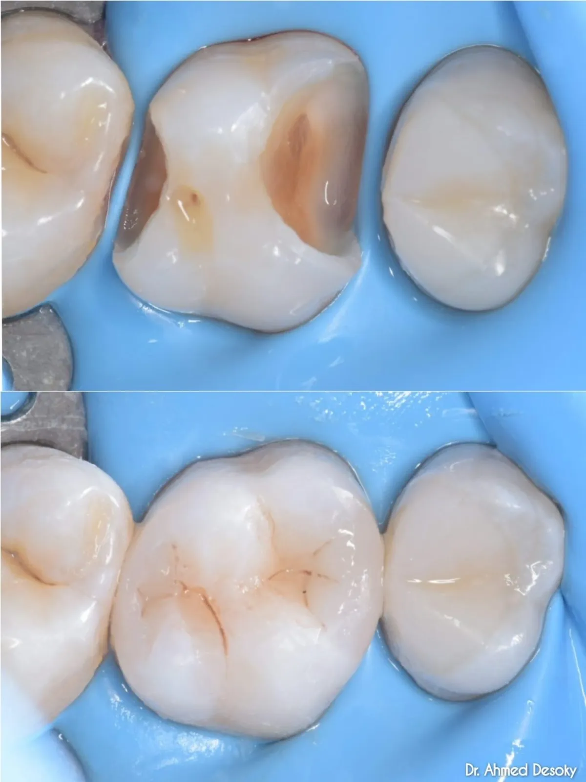Restoration with Nanofill unique, Clinical Case