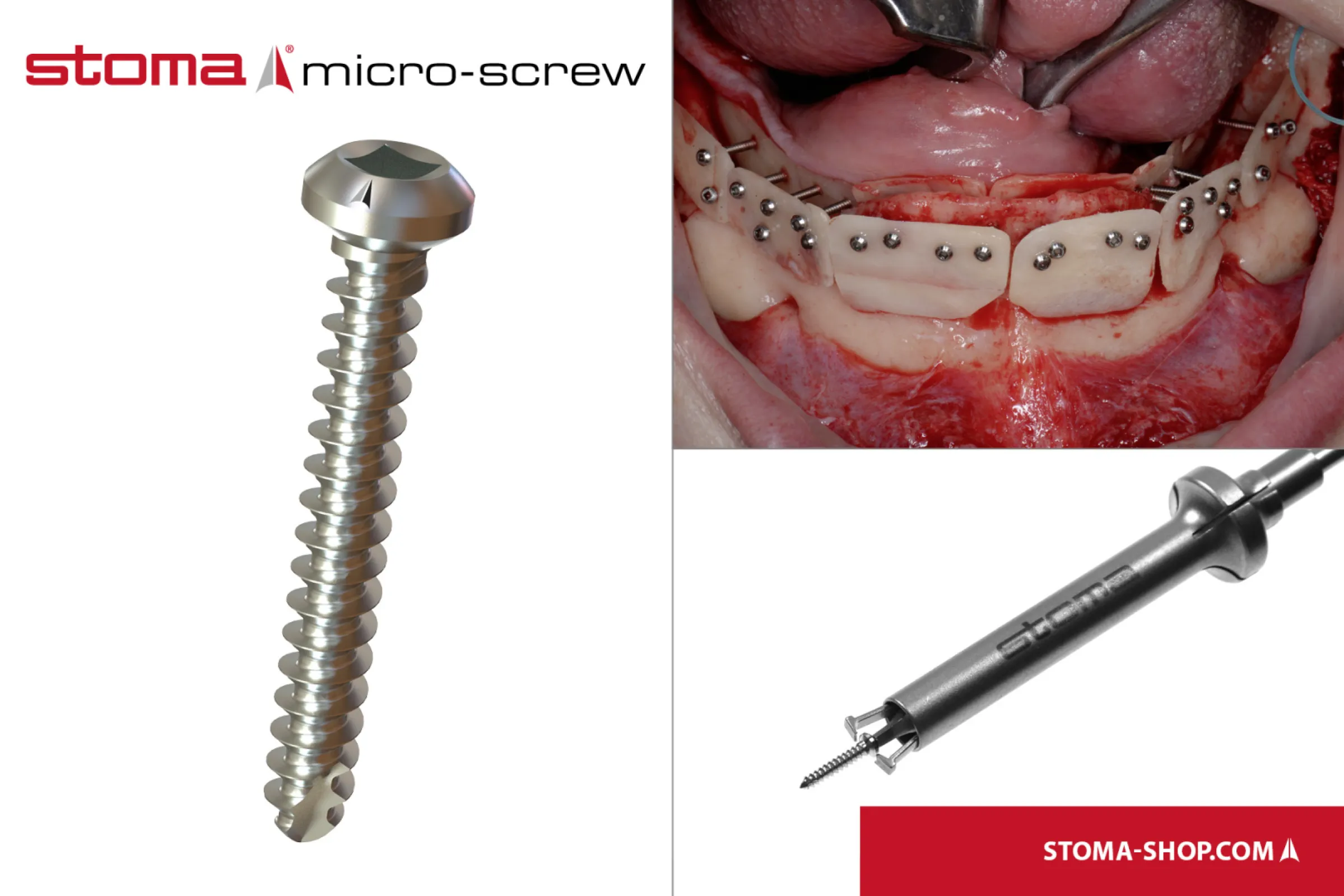 stoma® micro-screw
