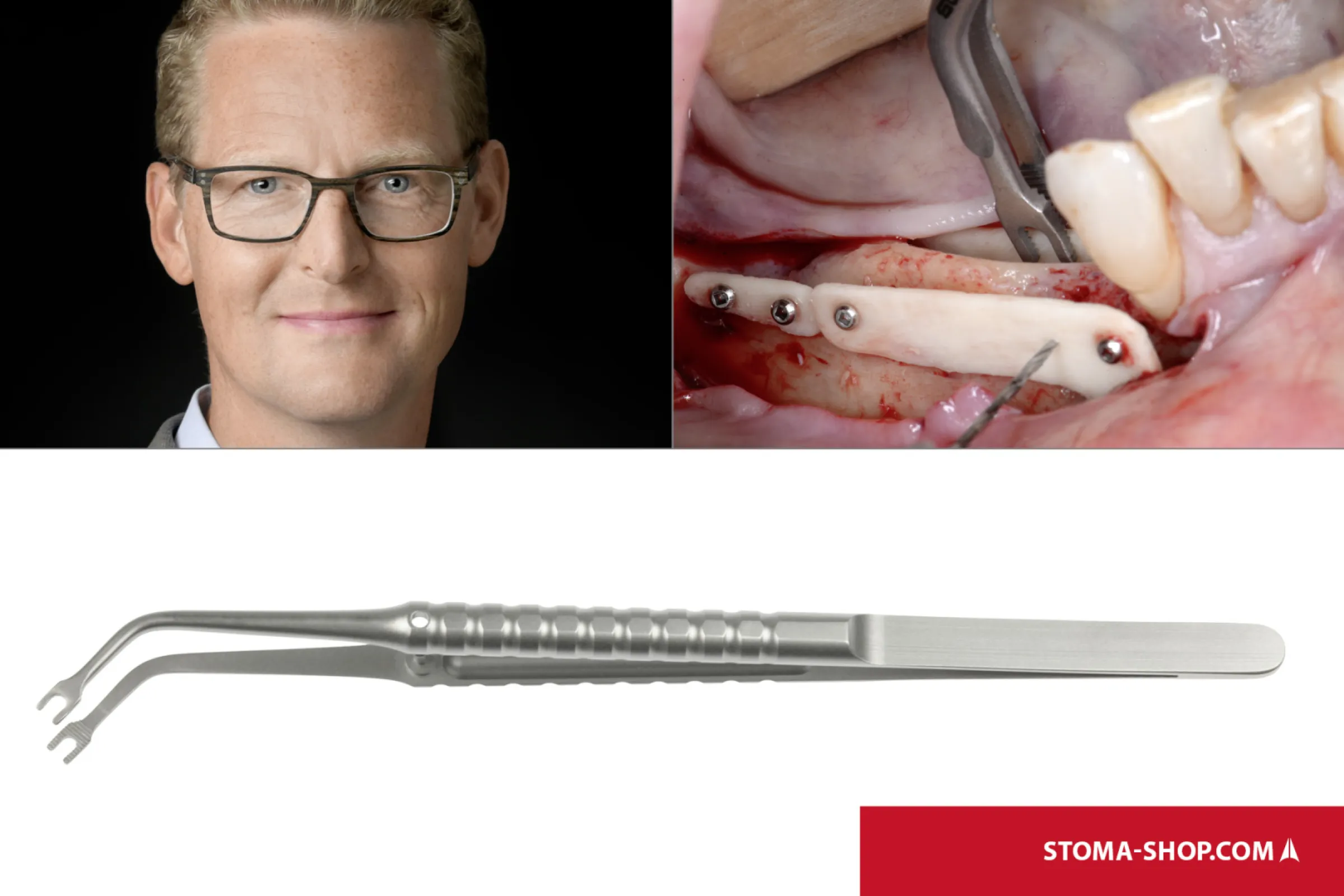 Bone graft holding forceps acc. to Dr. Jochen Tunkel