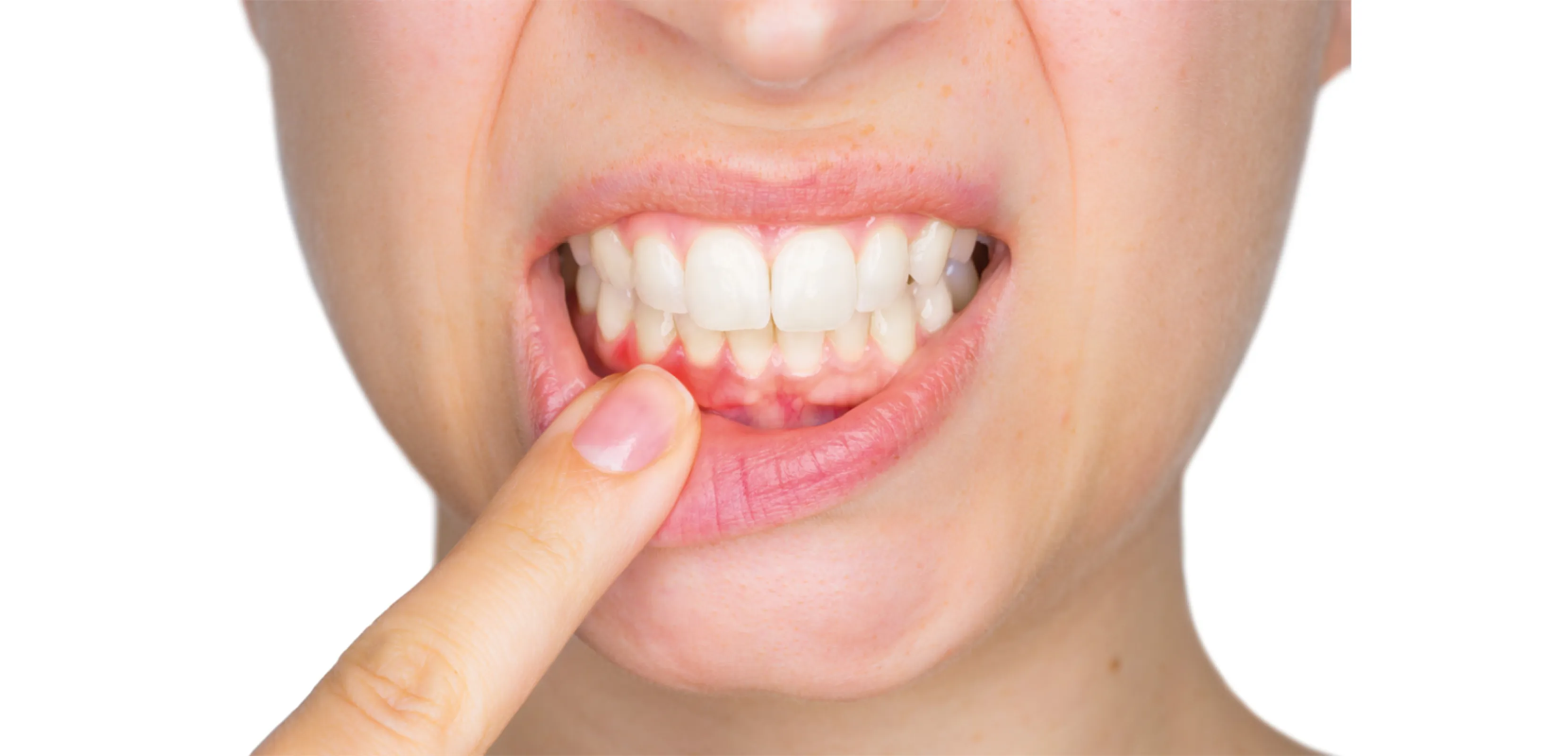 Treating pregnancy gingivitis with GingivaFit at home and Perio3Oil for professionals - with all natural gum gels.