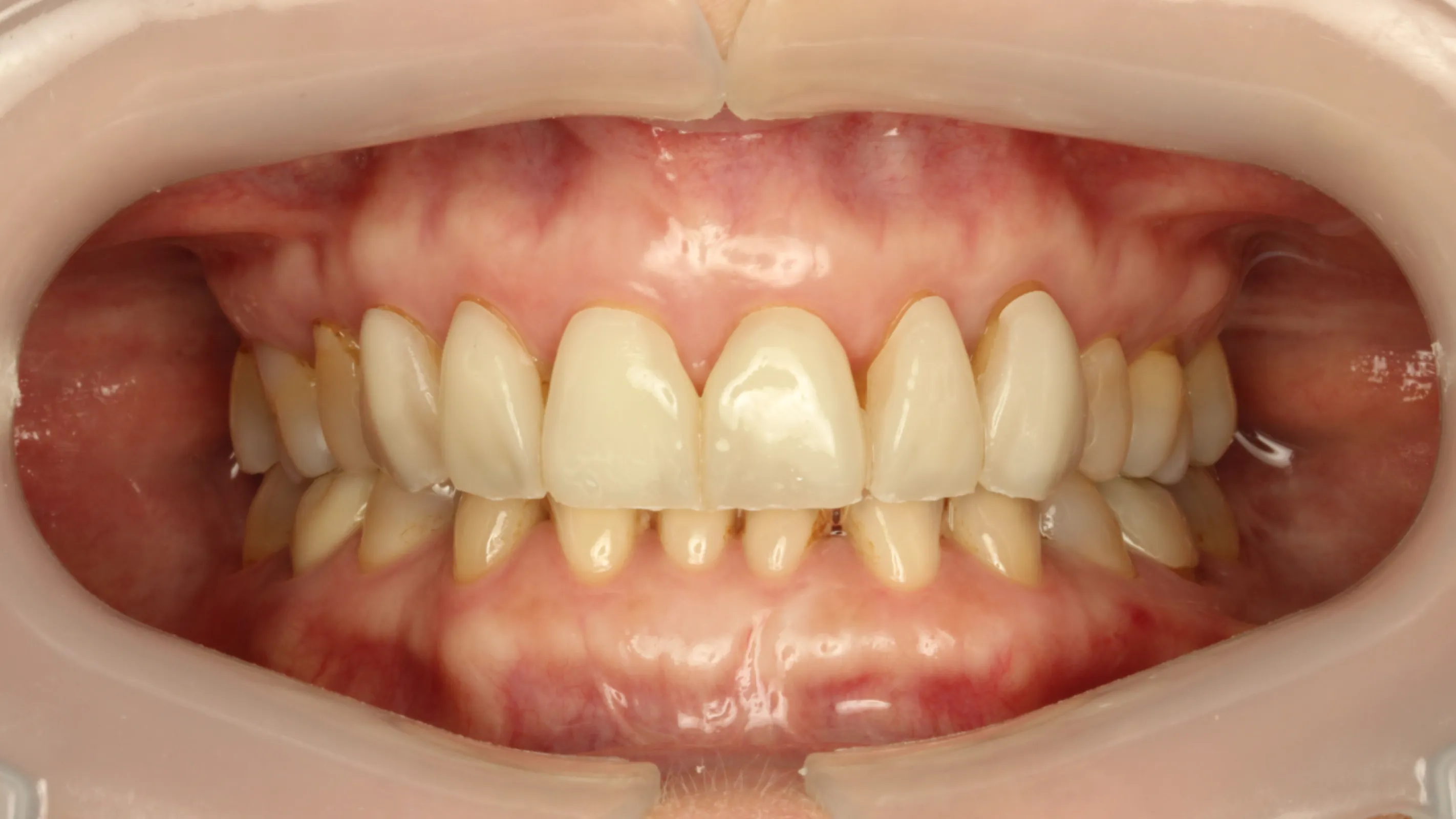 3Delta Crown intra-oral use - picture by Dr Andrew Ip