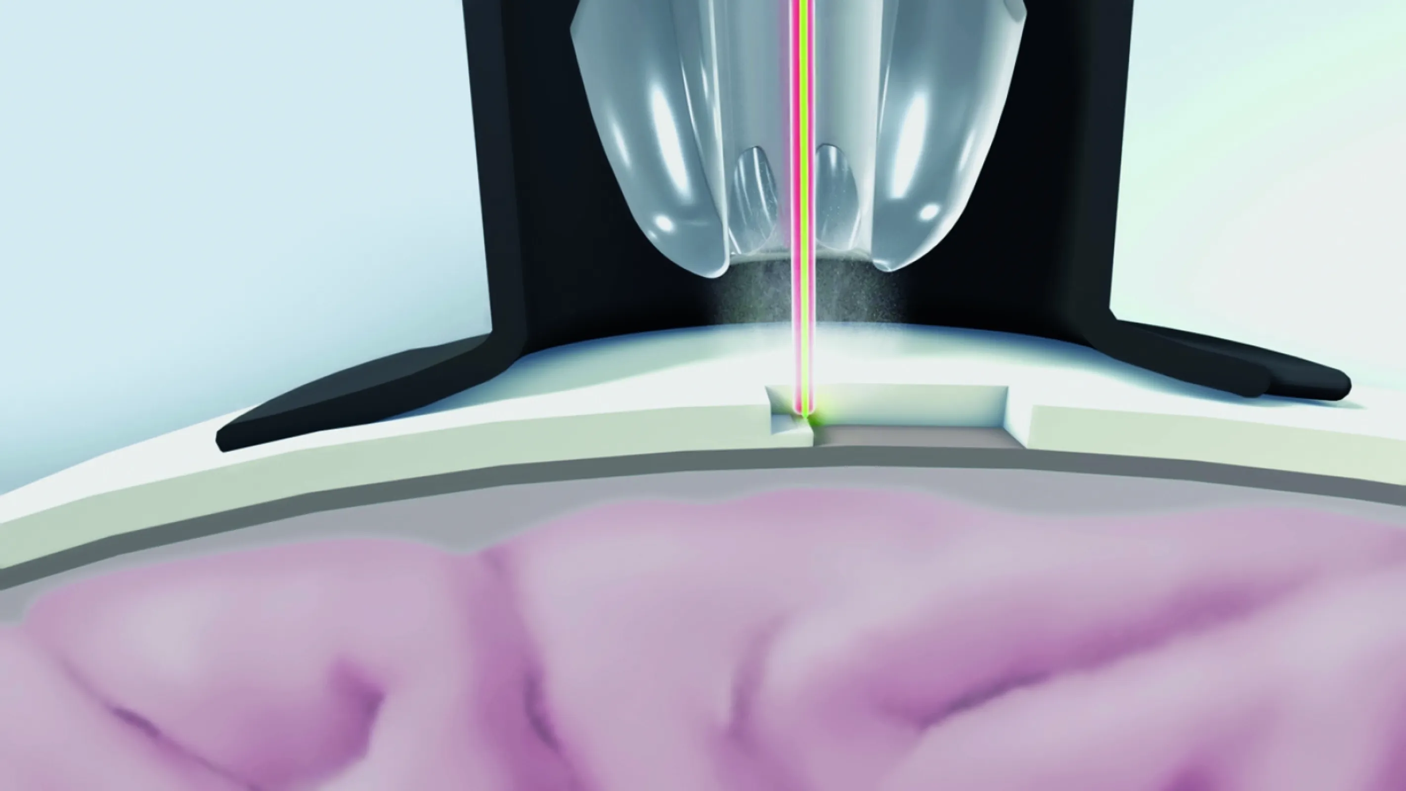 Applicator fpr implementing the laser cutting process on the skul bone | Copyright Fraunhofer ILT, Aachen, Germany