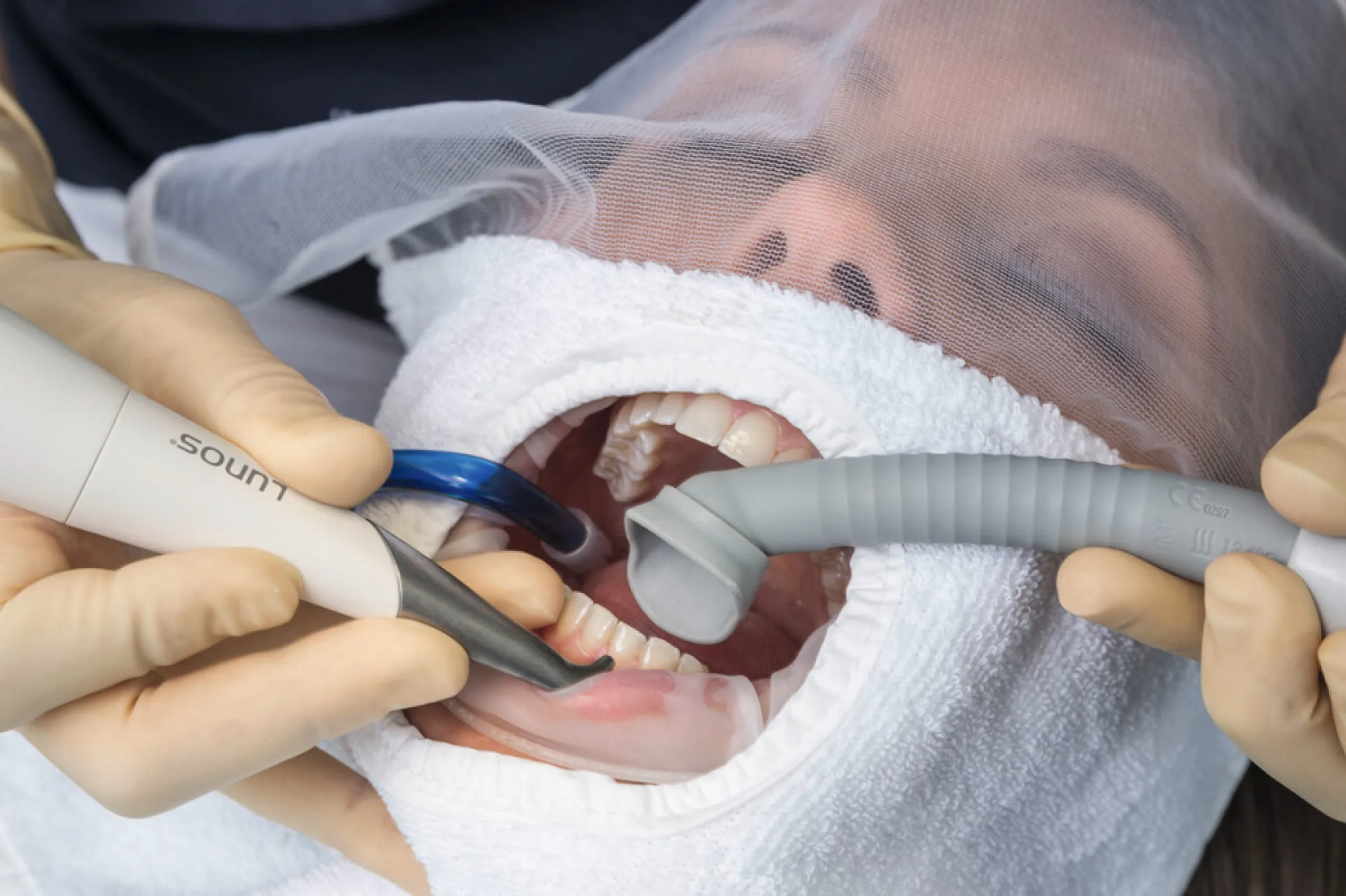 Prophylactic Treatment with MyLunos Air Polisher