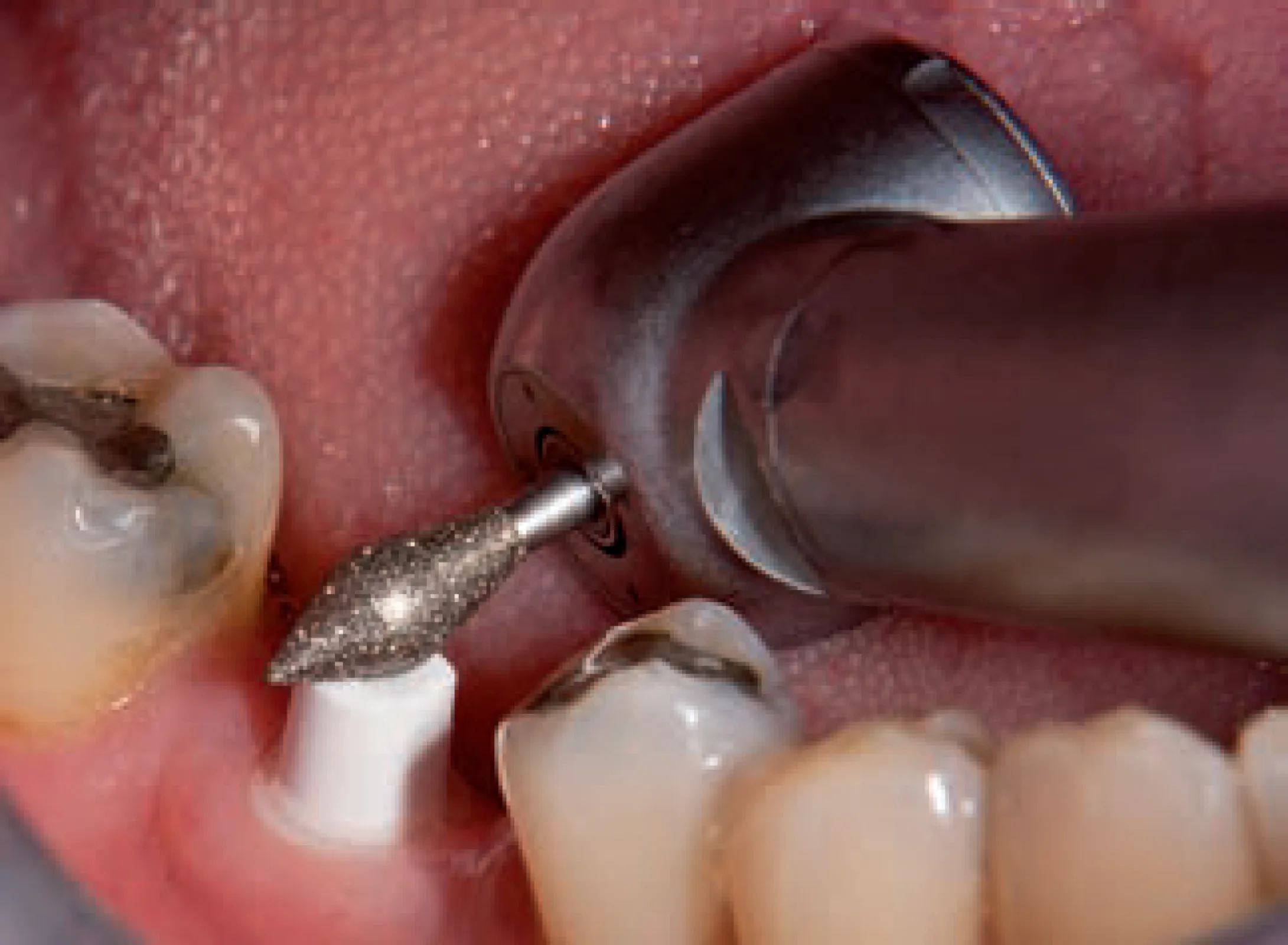 NTI Z-Cut FG Diamond Instruments