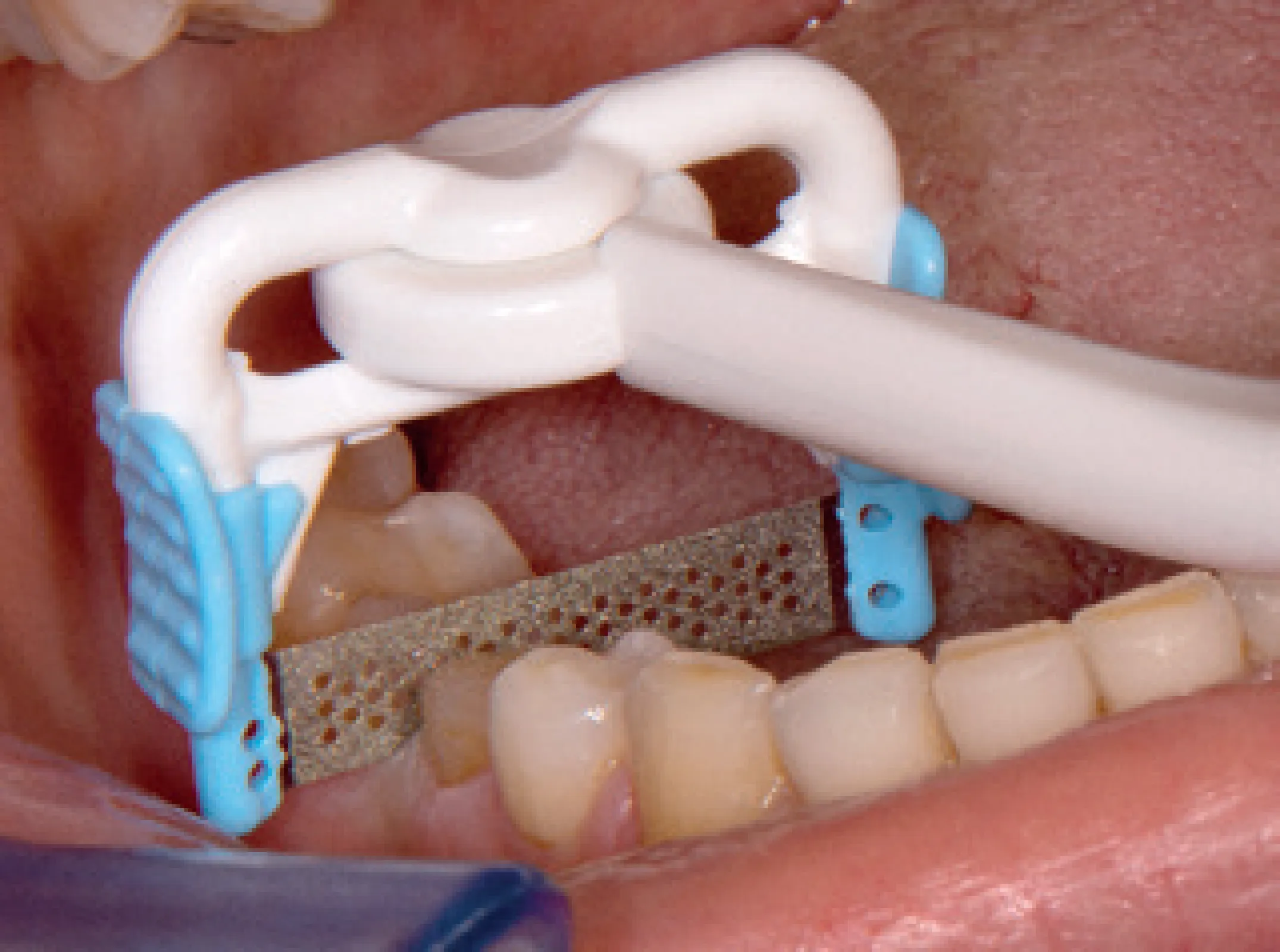 NTI - ProxyStrip