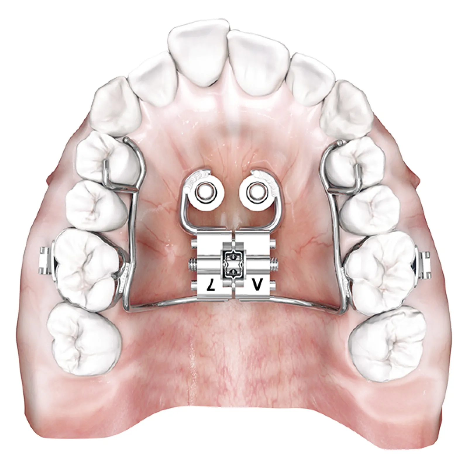 tomas® hybrid RPE