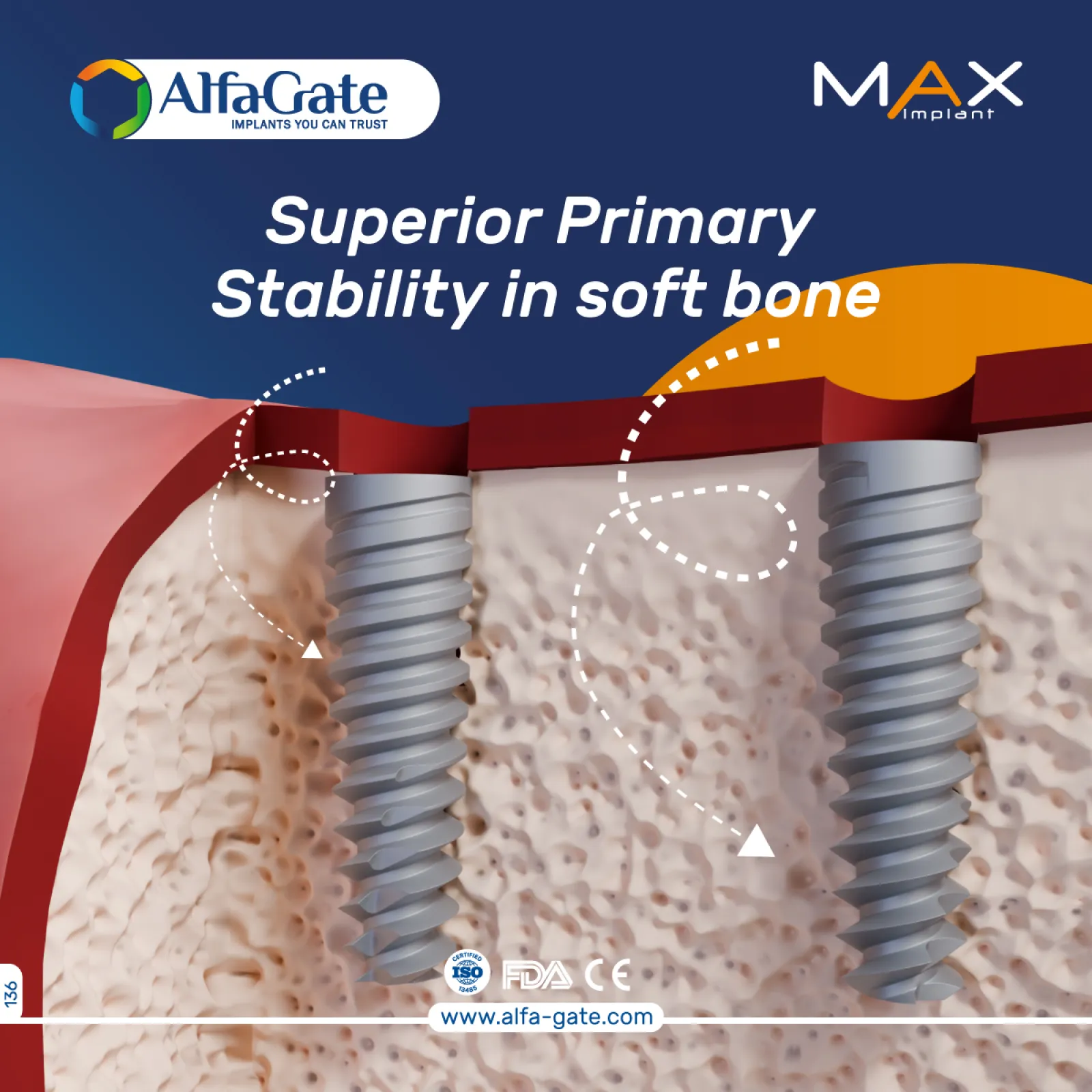 Max Implant
